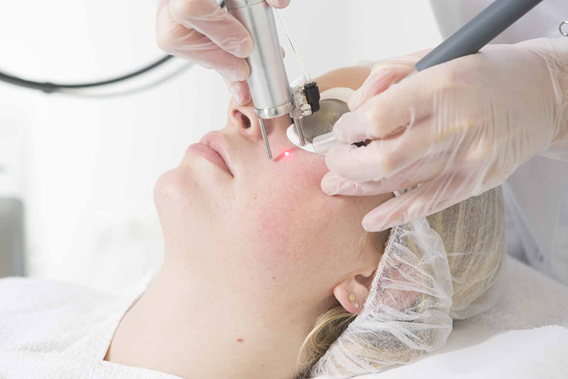 Couperose Behandlung Wien Mit Laser Bei Aestomed